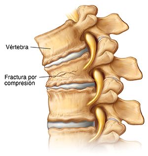 Vista lateral de las vértebras y los discos que muestra fracturas por compresión en las vértebras.