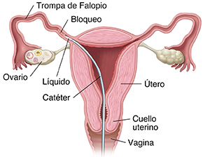 Vista frontal del útero que muestra el catéter administrando líquido en una trompa de Falopio obstruida.