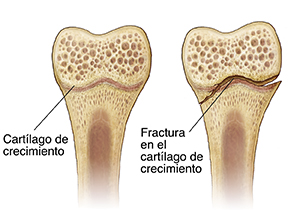 Corte transversal de un hueso donde puede verse la placa de crecimiento y la placa de crecimiento fracturada
