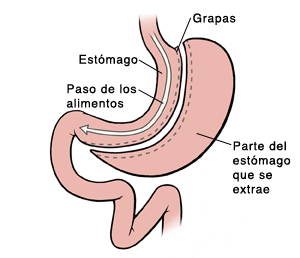 Vista frontal del estómago y del primer segmento del intestino delgado. Se cortó el estómago para formar una pequeña bolsa en su parte superior. Se quitó el resto del estómago. Se usan grapas para cerrar los bordes cortados. La flecha muestra el recorrido de la comida desde la pequeña bolsa hacia el intestino delgado.