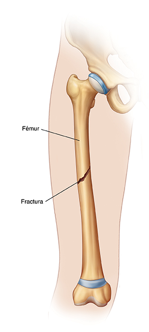 Contorno de una pierna en la que se observa una fractura en la mitad del fémur.