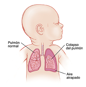 Primer plano de un bebé con la cabeza hacia un lado en el que se ven las vías respiratorias y los pulmones. Hay aire atrapado alrededor del pulmón izquierdo, que está colapsado.
