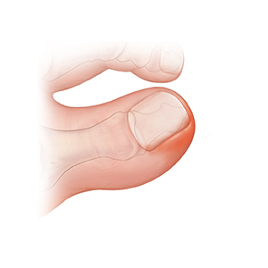 Primer plano de un dedo gordo del pie con una uña encarnada que causa inflamación.