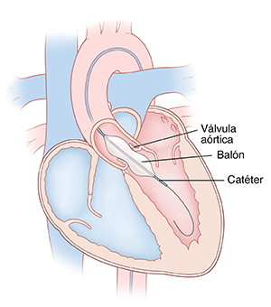 Corte transversal de vista frontal de un corazón donde pueden un catéter en el ventrículo izquierdo a través de la aorta. El balón del catéter se infla y ensancha la válvula aórtica.