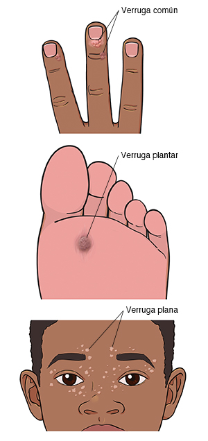 Verruga común en el extremo de un dedo de una mano. Verruga plantar en la planta de un pie. Verrugas planas en la cara.