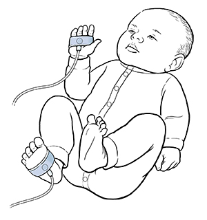Bebé con sensores de oxígeno alrededor de la mano y del pie.