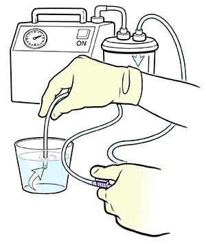 Mano con guante sumergiendo el extremo de una sonda de aspiración para traqueostomía en un recipiente con solución salina.