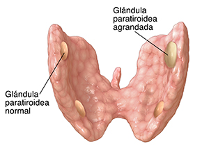 Vista posterior de la glándula tiroidea donde pueden verse tres glándulas paratiroideas normales y una agrandada.