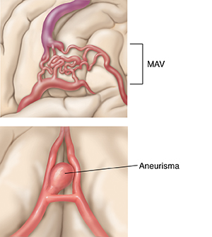 Primer plano de una malformación arteriovenosa (MAV) en el cerebro. Primer plano de un aneurisma en el cerebro.