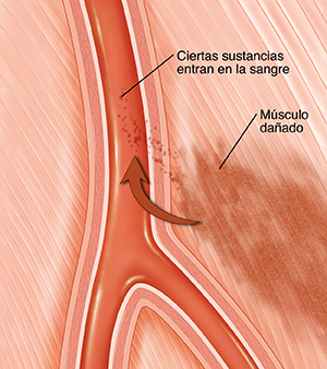 Corte transversal de una arteria en un músculo. El músculo que está junto a la arteria está dañado. Una flecha muestra sustancias provenientes del músculo dañado que ingresan al torrente sanguíneo a través de la pared de la arteria.