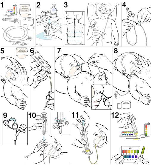 12 pasos para colocarle una sonda nasogástrica a un bebé.