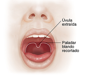 Vista frontal de una cara en la que se ven los senos paranasales y la boca abierta. La línea de puntos muestra los tejidos del paladar blando que se extraerán.