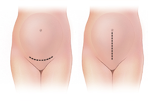 Vista frontal de un torso masculino donde pueden verse los órganos reproductivos.