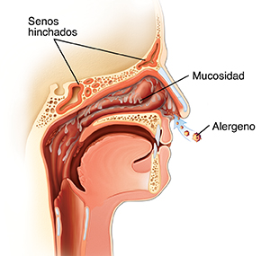 Corte transversal visto de lado de una cabeza que muestra alérgenos que ingresan en la nariz; el recubrimiento nasal inflamado y líquido que gotea desde el recubrimiento nasal.