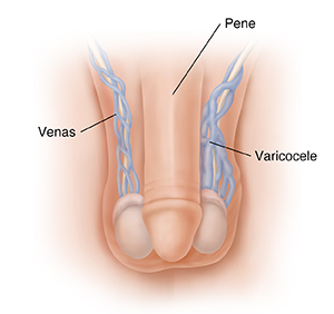 Vista frontal de genitales masculinos con varicocele.