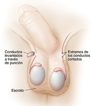 Vista frontal de un pene y un escroto donde pueden verse los conductos deferentes durante una vasectomía y después.