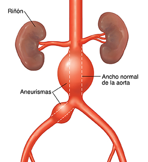 La imagen muestra aneurismas, el ancho normal de la aorta y los riñones.