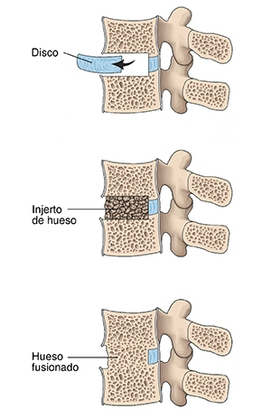 Corte transversal de las vértebras lumbares donde se observan los tres pasos de la fusión lumbar.