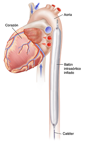 Vista lateral del corazón durante la diástole en la que se observa un balón intraaórtico de contrapulsación inflado en la aorta