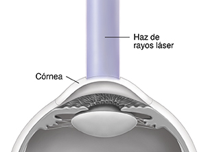 Corte transversal lateral del frente de un ojo en donde se ve un colgajo de córnea doblado hacia atrás y un rayo láser sobre la córnea.