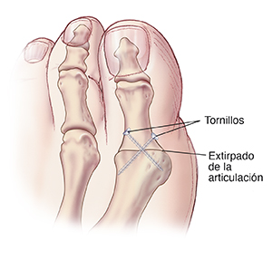 Vista superior de un dedo gordo del pie con tornillos que sostienen los huesos juntos después de extirpar la articulación.