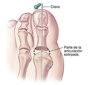 Vista superior de un dedo gordo del pie con clavo que atraviesa la parte superior del dedo para separar los huesos después de extirpar de la articulación.