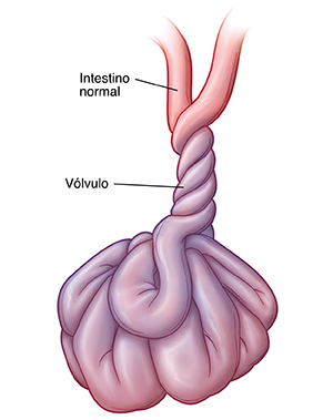 Vista frontal de un intestino retorcido sobre sí mismo (vólvulo).