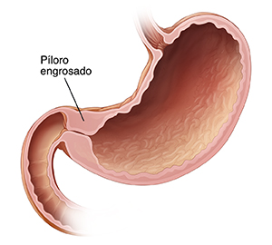Corte transversal del estómago con el píloro engrosado.