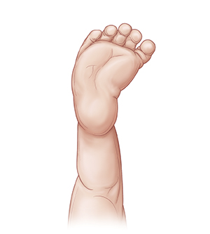 Contorno de la pierna de un bebé que muestra la parte delantera del pie girada hacia adentro (MTA).