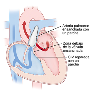 Corte transversal de un corazón donde se observa la reparación de la tetralogía de Fallot.