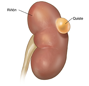 Vista frontal de un riñón con un quiste simple.
