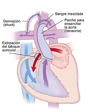 Corte transversal de vista frontal de un corazón que muestra el procedimiento de Norwood. Un parche ensancha la aorta (neoaorta), se quita el tabique auricular y se coloca una derivación en una arteria que se ramifica desde la aorta hasta la arteria pulmonar. Las flechas muestran que la sangre fluye de la aurícula izquierda al ventrículo derecho y que la sangre mezclada pasa del ventrículo derecho a la aorta. Algo de sangre proveniente de la aorta pasa por la derivación y va hacia la arteria pulmonar.