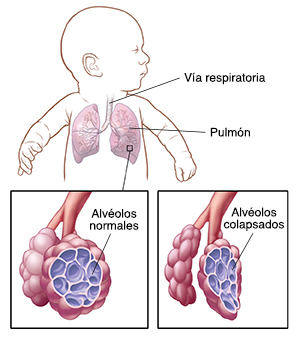 Bebé con la cabeza hacia un lado en el que se ven las vías respiratorias y los pulmones. Primer plano de las vías respiratorias y alvéolos normales. Primer plano de las vías respiratorias y alvéolos colapsados.