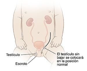 Vista frontal de un bebé donde puede verse el sistema genitourinario con una flecha que muestra el testículo que se lleva a una posición normal.