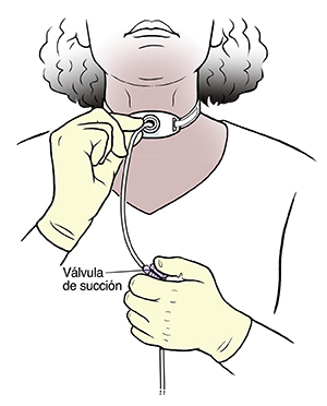 Mujer introduciendo una sonda de aspiración en la cánula de traqueostomía del cuello.