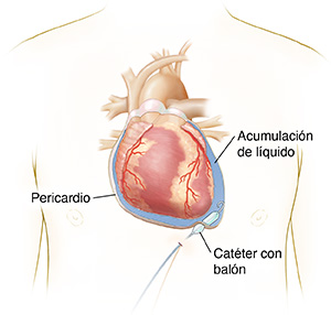 Vista frontal del pecho de una persona donde se observa el corazón y un corte transversal del pericardio. Se infla un catéter con balón en el pericardio.