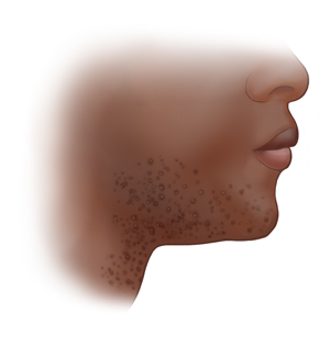 Vista lateral de una barbilla con pequeñas protuberancias de color rojo en la mandíbula, la barbilla y el cuello.
