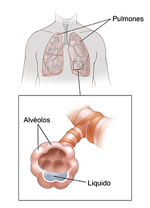 Vista frontal del pecho donde pueden verse los pulmones. En el recuadro se muestran los alvéolos llenos de líquido.